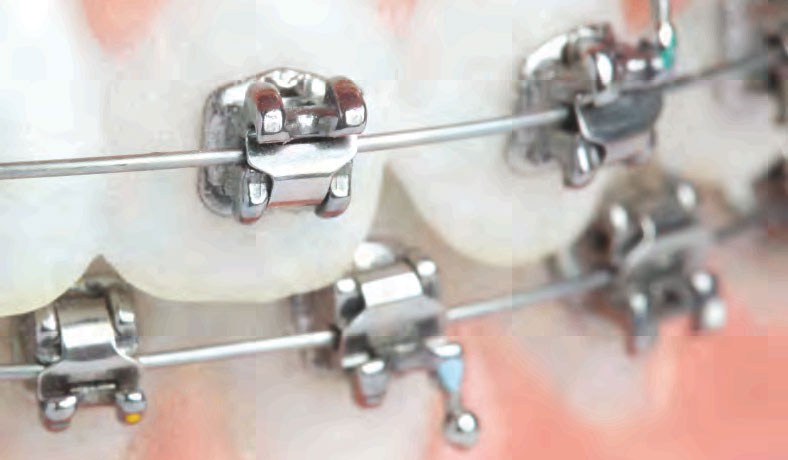 Orthodontic Wire – An Overview